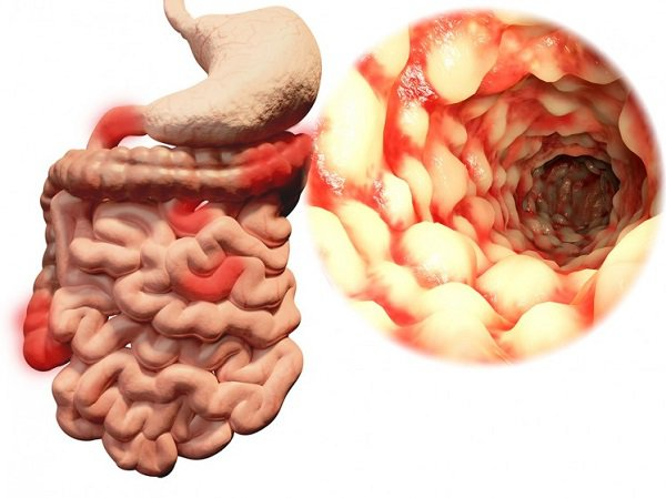 Viêm ruột (IBD) là gì? Tổng quan về bệnh