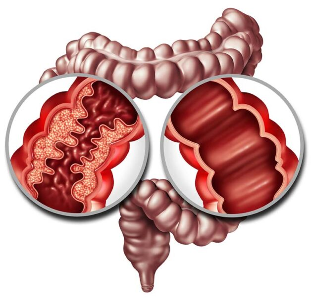 Cách sử dụng men vi sinh cho người bệnh viêm ruột