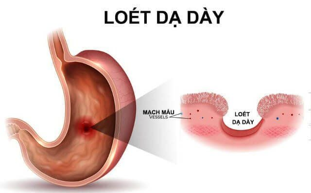 Viêm loét dạ dày là gì và nguyên nhân gây bệnh?